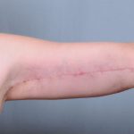 Brachioplasty Before & After Patient #1851