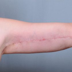 Brachioplasty Before & After Patient #1851