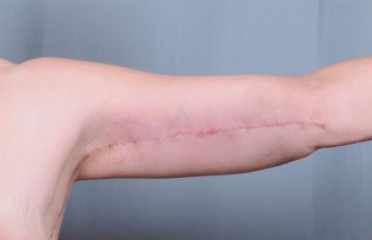 Brachioplasty Before & After Patient #1851