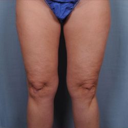Liposuction Before & After Patient #1860