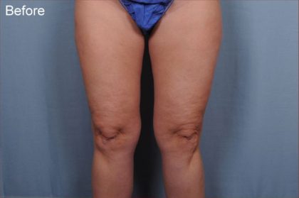Liposuction Before & After Patient #1860