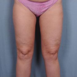 Liposuction Before & After Patient #1860