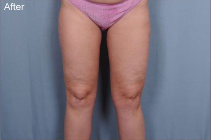 Liposuction Before & After Patient #1860