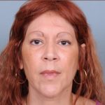 Liposuction Before & After Patient #1859