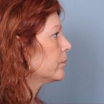 Liposuction Before & After Patient #1859