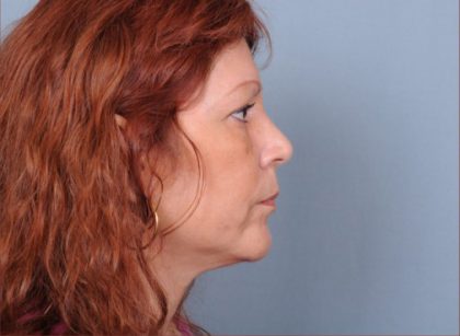 Liposuction Before & After Patient #1859