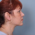 Liposuction Before & After Patient #1859