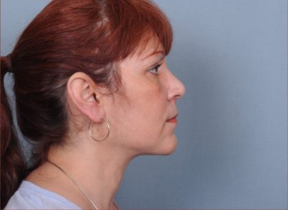 Liposuction Before & After Patient #1859