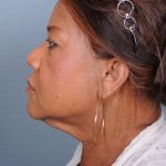 Liposuction Before & After Patient #1858