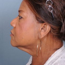Liposuction Before & After Patient #1858