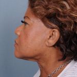 Liposuction Before & After Patient #1858