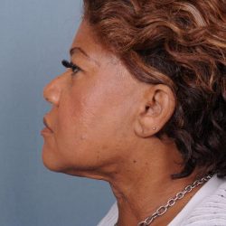 Liposuction Before & After Patient #1858