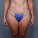 Liposuction Before & After Patient #1857