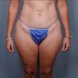 Liposuction Before & After Patient #1857