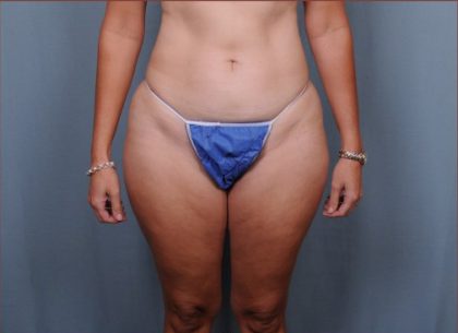 Liposuction Before & After Patient #1857