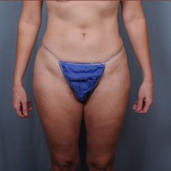 Liposuction Before & After Patient #1857