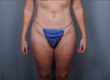 Liposuction Before & After Patient #1857