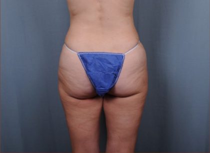 Liposuction Before & After Patient #1857
