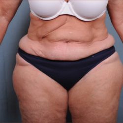 Liposuction Before & After Patient #1856