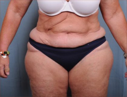 Liposuction Before & After Patient #1856