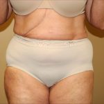 Liposuction Before & After Patient #1856