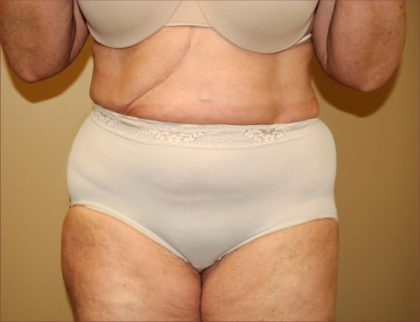 Liposuction Before & After Patient #1856