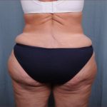 Liposuction Before & After Patient #1856