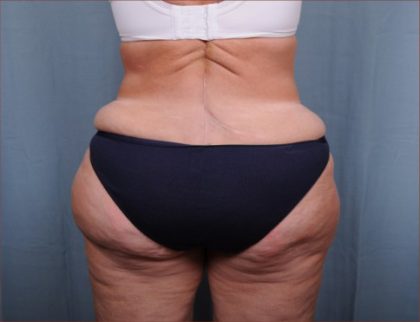 Liposuction Before & After Patient #1856