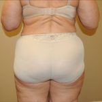 Liposuction Before & After Patient #1856