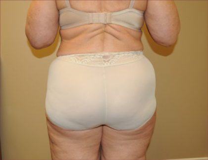 Liposuction Before & After Patient #1856