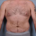 Liposuction Before & After Patient #1855