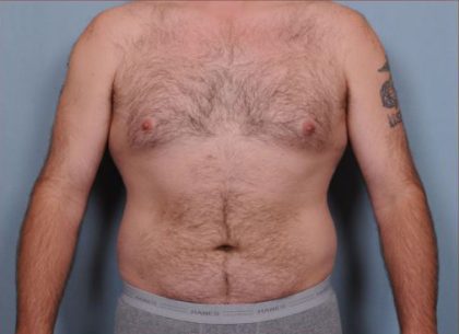 Liposuction Before & After Patient #1855
