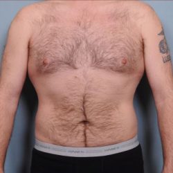 Liposuction Before & After Patient #1855