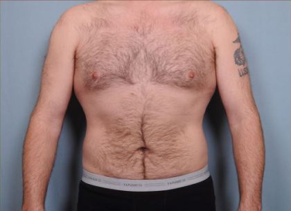 Liposuction Before & After Patient #1855