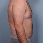 Liposuction Before & After Patient #1855