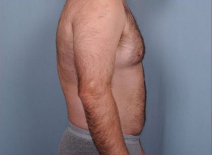 Liposuction Before & After Patient #1855