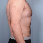 Liposuction Before & After Patient #1855