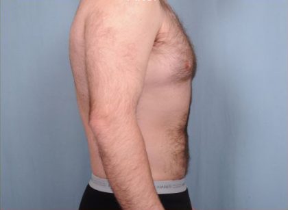 Liposuction Before & After Patient #1855