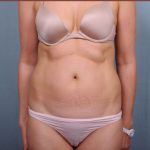 Liposuction Before & After Patient #1854