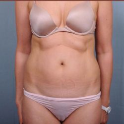 Liposuction Before & After Patient #1854