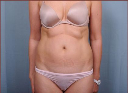 Liposuction Before & After Patient #1854