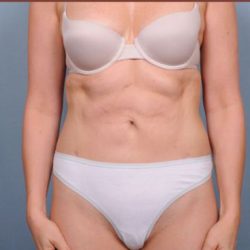 Liposuction Before & After Patient #1854