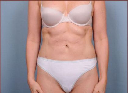 Liposuction Before & After Patient #1854