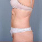 Liposuction Before & After Patient #1854