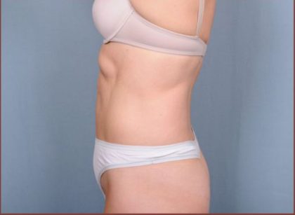 Liposuction Before & After Patient #1854