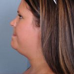 Liposuction Before & After Patient #1871