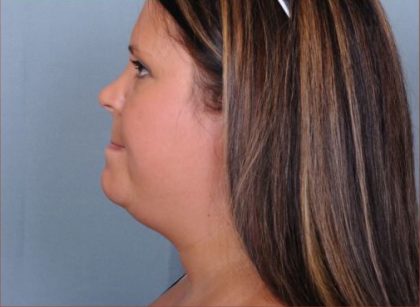 Liposuction Before & After Patient #1871