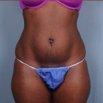 Liposuction Before & After Patient #1870