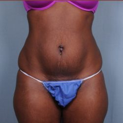 Liposuction Before & After Patient #1870