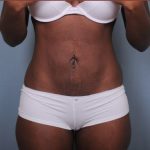 Liposuction Before & After Patient #1870